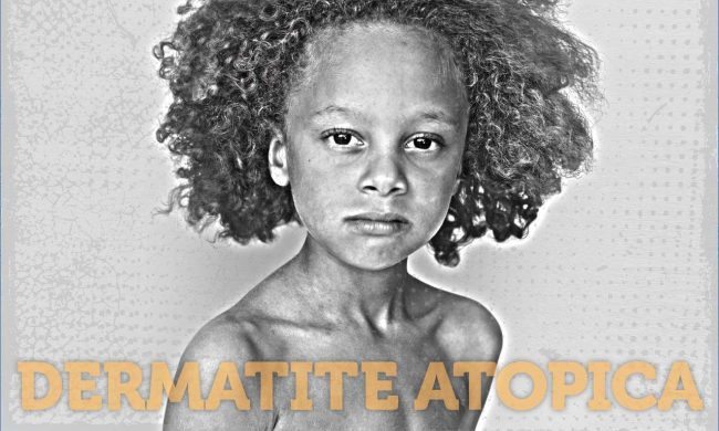 03 Dermatite atopica