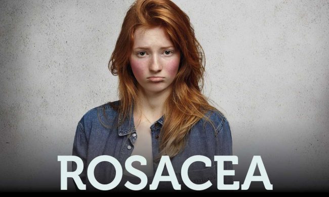 Rosacea-062017